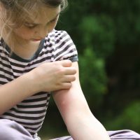 stop itchy bites